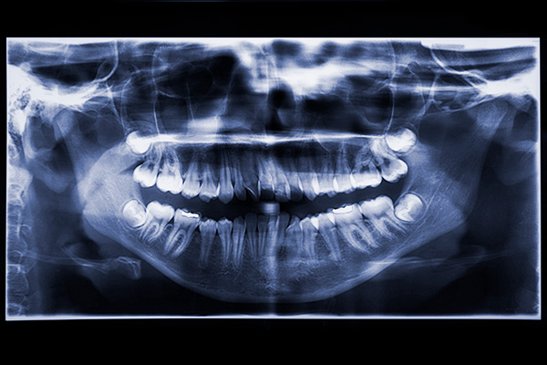 Digital X-ray of teeth