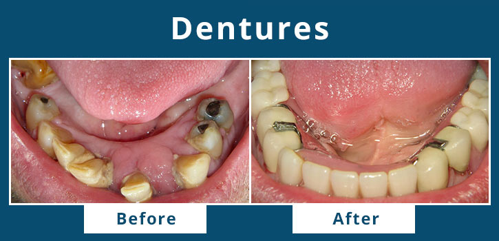 dentures4