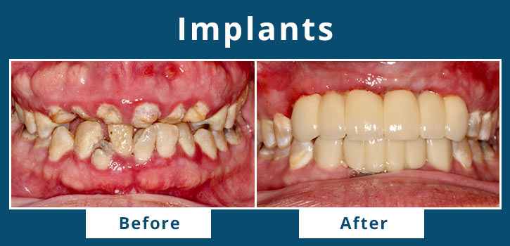 implants2